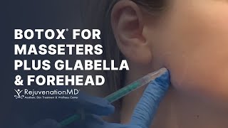 Botox for Masseters Alleviate Teeth Clenching TMJ and Grinding [upl. by Nodnyl]