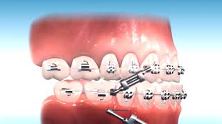 How to correct Class III Malocclusion [upl. by Ettevy907]