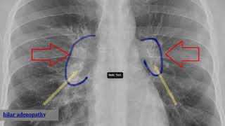 bilateral hilar adenopathy [upl. by Nivled345]