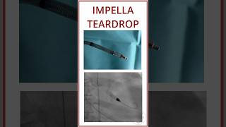 IMPELLA TEARDROP IN FLUOROSCOPY SCREW CONNECTION [upl. by Etterrag]