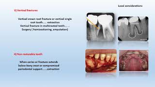 Fall 2020  Endodontic 3  Lec 2  case selection amp ttt plan Part 1 [upl. by Amando888]