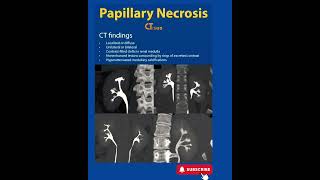 Papillary Necrosis  CT  Radiology [upl. by Dahaf]