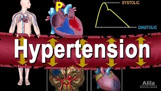 Hypertension  High Blood Pressure Animation [upl. by Yregram]