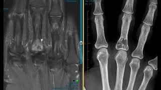 Lytic lesion finger on xray [upl. by Hpesojnhoj]