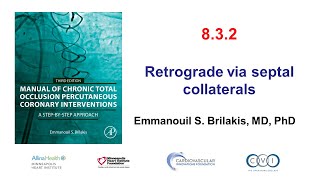 832 Manual of CTO PCI  Retrograde via septal collaterals [upl. by Haila417]