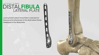 Zimed  Locking Distal Lateral Fibula Plate [upl. by Benisch291]