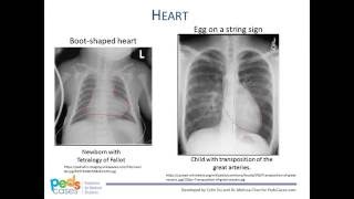 Approach to Pediatric Chest XRays [upl. by Retha]