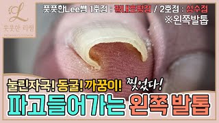 까꿍이 눌린자국 파고들어가는 왼쪽발톱 관리 아직 반대쪽발톱 남았어요 ingrown toenail  Fresh Foot 풋풋한리쌤 성수점  평내호평점 [upl. by Ramsdell]