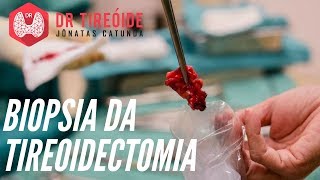 Resultado da biópsia da tireoidectomia  Como interpretar  Dr Jônatas Catunda [upl. by Ewald121]