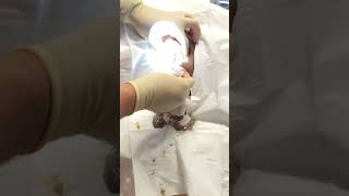 Exploding grapefruit sized sebaceous cyst popping [upl. by Idnerb340]