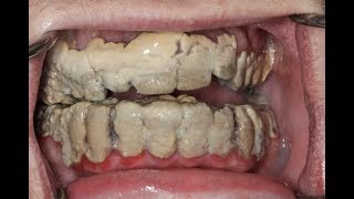 20 Years Without Brushing Teeth 😦  Calculus Removal [upl. by Aulea]