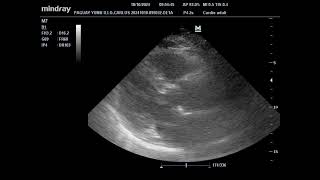 ecocardiograma en paciente con marcapaso unicameral [upl. by Ahsaf]