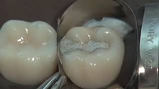 Class II Amalgam Preparation amp Restoration  Operative Dentistry [upl. by Enaitsirhc]