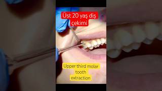 Upper 3molar tooth extraction [upl. by Koenig448]