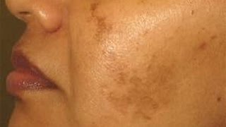 5 Home Remedy for Pigmentation Hyperpigmentation Brown Spots Discoloration NaghmaSyed [upl. by Bannerman]