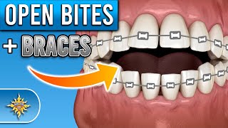 HOW BRACES WORK  TIMELAPSE Before and After Amazing Open Bite correction [upl. by Darci]