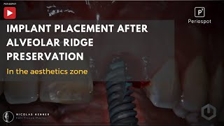 Implant Placement After Alveolar Ridge Preservation  Dr Nicolas Henner [upl. by Filemon289]