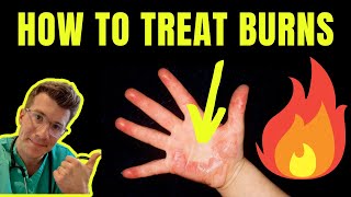 HOW TO TREAT AND MANAGE BURNS AND SCALDS  DOCTOR EXPLAINS plus first aid tips [upl. by Ludovico819]