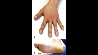 Trommelschlegelfinger und Uhrglasnägel bei primärer hypertropher Osteoarthropathie Typ 1 [upl. by Bolitho690]