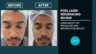 Laser Skin Resurfacing Treatment Procedure Reviews And Results [upl. by Helene]