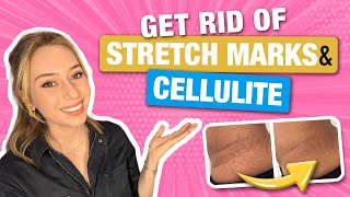 How to Get Rid of Stretch Marks amp Cellulite from a Dermatologist  Dr Shereene Idriss [upl. by Gregorio]