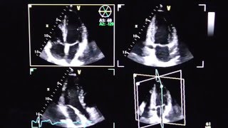 Triplane Echokardiographie triplane echocardiography [upl. by Story]