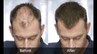 Seborrheic Dermatitis Hair Loss Before And After Seborrheic Dermatitis Hair Loss Before And After [upl. by Sivatnod439]