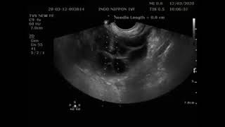 Ultrasound Guided Transvaginal Oocyte Retrieval [upl. by Enirual239]