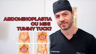 ABDOMINOPLASTIA OU MINI TUMMY TUCK  DR PAULO DUARTE [upl. by Merras]