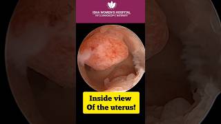 Hysteroscopic polyp removal surgery live  DrChinmay Pataki  Isha Women’s Hospital [upl. by Anisamoht]