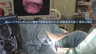 子宮頸部筋腫 子宮鏡下摘出術 cervical submucosal fibroid hysteroscopic resection [upl. by Consolata]