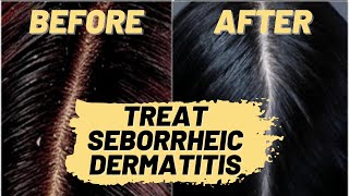 How to Treat Seborrheic Dermatitis Natural Hair Treatment  Repair Your Scalp amp Hair Loss [upl. by Ynohtnael]