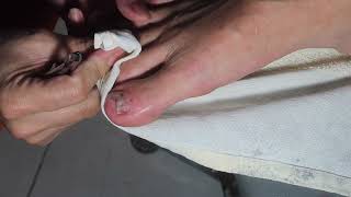 How to Fix Damaged Toenails Simple Solutions for Beautiful Feet [upl. by Nylarat]