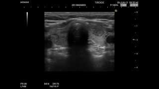 Struma Multinodulare Tiroide EndocrinologiaOggi [upl. by Ezekiel]