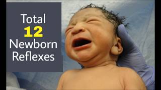 Newborn Reflexes I Neonatal Reflexes [upl. by Ennairac279]