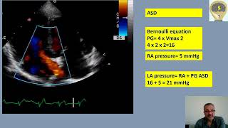 Case Study 5 Left Atrial Pressure Measurement with ASD [upl. by Wenoa]