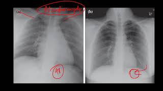 PA vs AP view  Chest radiology [upl. by Meier675]