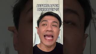 Before after demapen 15 dermapen dermapenmicroneedling bopeng [upl. by Nuahsak]