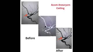 Aneurysm coiling by suresh giragani [upl. by Ahsekyw]