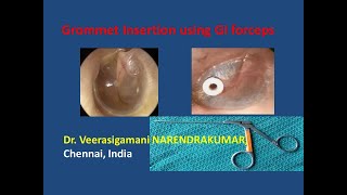 Grommet Insertion using GI Forceps Dr V Narendrakumar [upl. by Sloane]