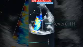 Severe TR Tricuspid Regurgitation Echo l echo heart shorts [upl. by Kerwinn740]