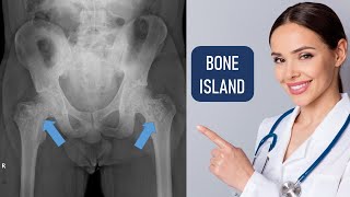 Bone Island  Bony Island  Enostoses  Osteoma  quotDon’t touch” Lesions in Xray [upl. by Anawed]