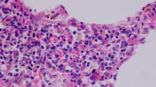 Cytomegalovirus in Lung with Haematoxylin and Eosin HampE Stain [upl. by Serle]