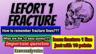 How to remember Lefort 1 fracture lineLEFORT 1 FRACTURE Linejust in 10 points [upl. by Nnaeirelav]