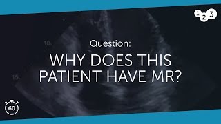 60 Seconds of Echo Teaching Question Why does this patient have MR [upl. by Engedus]