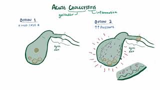 Acute cholecystitis causes symptoms diagnosis treatment amp pathology [upl. by Weixel]