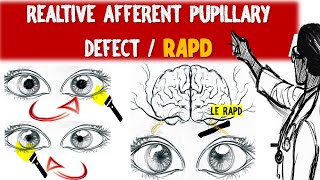 Understanding Relative Afferent Pupillary Defect RAPD amp Marcus Gunn pupil [upl. by Bergwall]