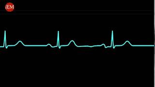 PEA  Pulseless electrical activity [upl. by Atsejam]