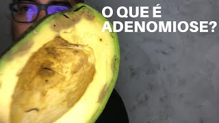 O QUE É ADENOMIOSE SINTOMAS E POSSÍVEIS CAUSAS [upl. by Berlyn475]