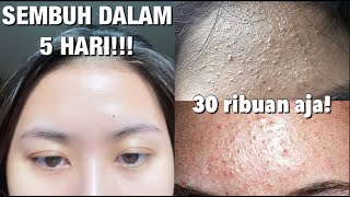 Skincare Routine Untuk Kulit BruntusanFungal Acne [upl. by Aicylla]